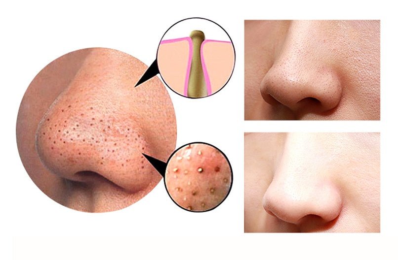 4 in 1 Body  Blackhead Remover Machine Facial Pore Deep Cleansing